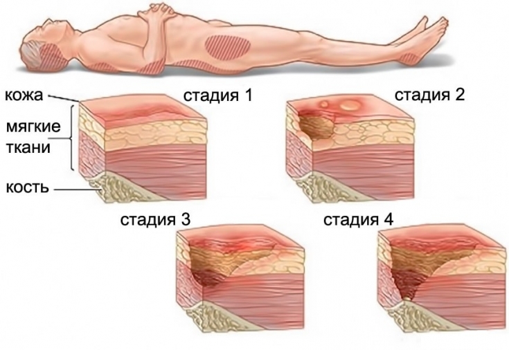 What are dangerous bedsores and how to prevent their occurrence Estet