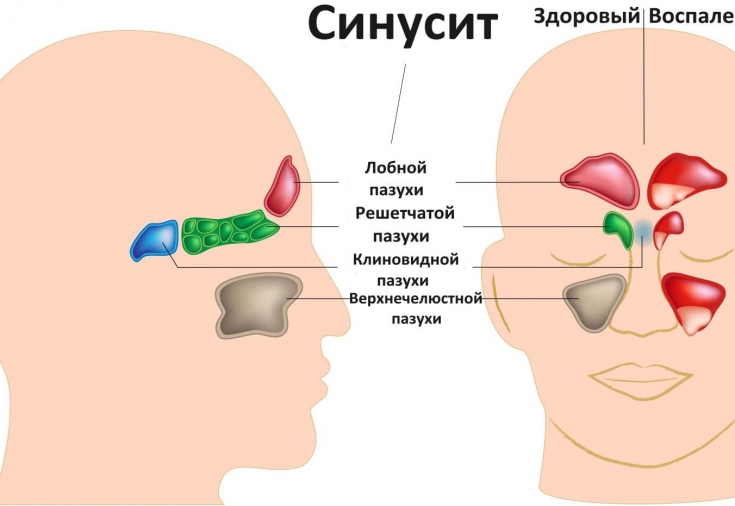 What are the symptoms of sinusitis caused by barotrauma? EstetPortal