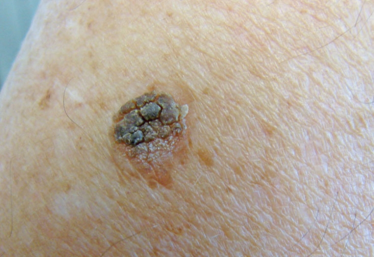 Keratosis cosmetic defect and its treatment EstetPortal
