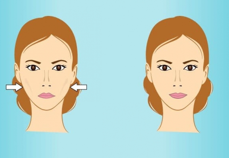 Cheekbone correction with fillers the desired shape in just one