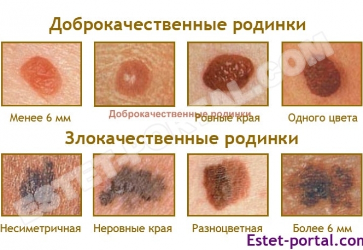 Signs that characterize dangerous moles EstetPortal