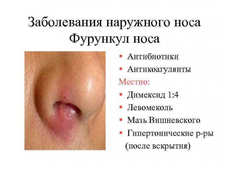 фурункул в носу