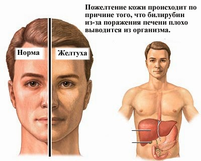 желтый цвет кожи