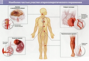 5-dobavok-i-trav-kotorye-pomogut-snizit-uroven-kholesterina-pri-ateroskleroze