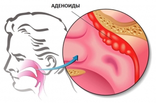 adenoidy-u-detej-prichiny-zabolevaniya-i-ego-posledstviya
