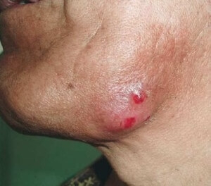 aktinomikoz-litsa-mozhet-provotsirovatsya-respiratornymi-infektsiyami