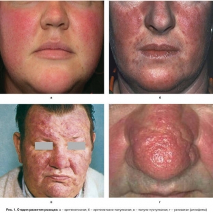 algoritm-reabilitatsii-patsientov-posle-lecheniya-rozatsea