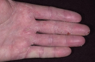 allergicheskij-dermatit-bomba-zamedlennogo-dejstviya