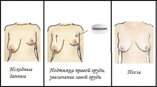 asimmetriya-grudi-operatsiya-pomozhet-vse-ispravit