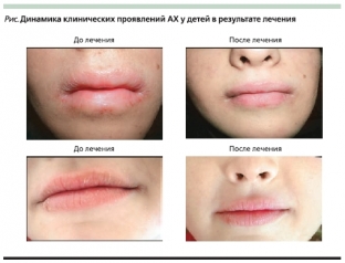 atopicheskij-khejlit-razvivaetsya-pri-plokhoj-gigiene-polosti-rta