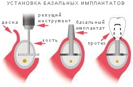 bazalnaya-implantatsiya-zubov-preimushchestva-metoda