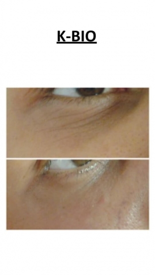 bezopasnaya-alternativa-botulotoksinu-in-ektsionnyj-miorelaksant-btx-tech-ot-k-surgery