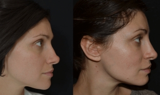 bezoperatsionnaya-rinoplastika-fillerami-eto-vozmozhno