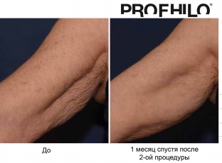 bioremodelirovanie-profhilo-kak-estestvennyj-protsess-omolozheniya-kozhi