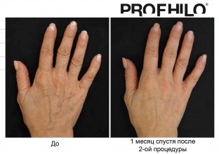 bioremodelirovanie-profhilo-kak-estestvennyj-protsess-omolozheniya-kozhi