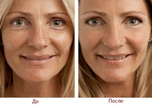 biorevitalizatsiya-do-i-posle-kak-ne-isportit-rezultaty-protsedury