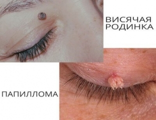 borodavki-rodinki-i-papillomy-chem-oni-otlichayutsya
