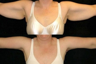 brakhioplastika-realizatsiya-mechty-o-krasivykh-rukakh