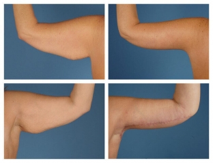 brakhioplastika-realizatsiya-mechty-o-krasivykh-rukakh