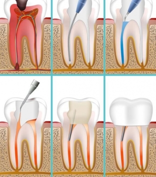 chem-opasen-granuliruyushchij-periodontit-prichiny-razvitiya-periodontita
