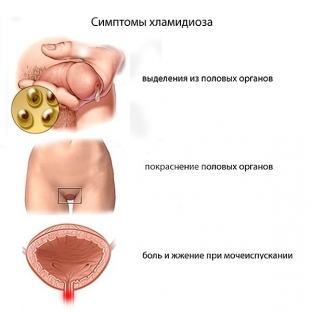 chem-osobenno-opasen-khlamidioz-u-muzhchin