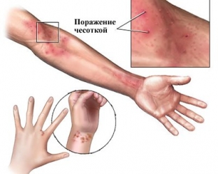 chesotka-pochemu-vazhno-svoevremenno-raspoznat-infektsiyu