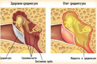 chto-delat-esli-zalozhilo-ukho-pri-prostude-i-rezkikh-perepadakh-davleniya