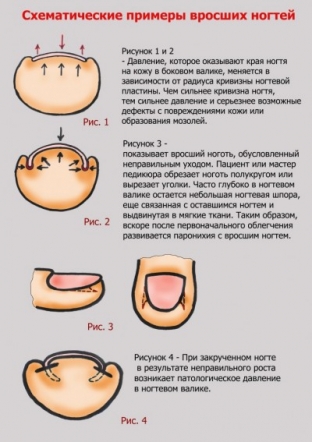 chto-provotsiruet-vrastanie-nogtej-i-kak-eto-predotvratit