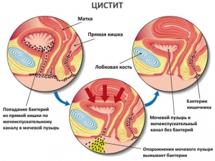 chto-sleduet-znat-o-tsistite