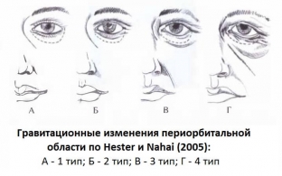 chto-vazhno-uchest-planiruya-khirurgicheskuyu-korrektsiyu-periorbitalnoj-oblasti