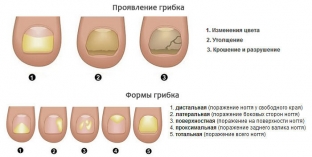 dejstvennye-sposoby-lecheniya-gribka-nogtej-stop-v-domashnikh-usloviyakh