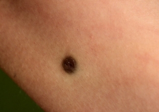 dermatofibrosarkoma-kak-proyavlyaetsya-opukhol-soedinitelnoj-tkani
