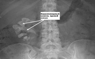 diagnostika-mochekamennoj-bolezni-kak-najti-kamen-v-pochke