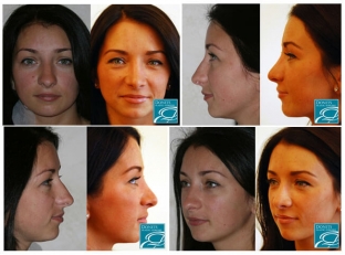 doktor-sdelajte-mne-krasivuyu-formu-nosa-nekotorye-sekrety-rinoplastiki