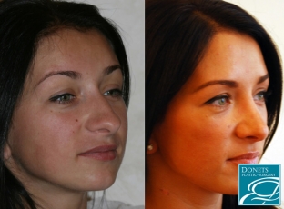 doktor-sdelajte-mne-krasivuyu-formu-nosa-nekotorye-sekrety-rinoplastiki