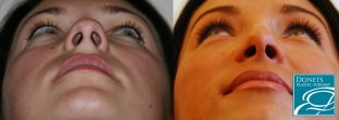 doktor-sdelajte-mne-krasivuyu-formu-nosa-nekotorye-sekrety-rinoplastiki