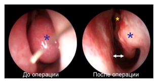 effektivnoe-lechenie-sinekhij-v-polosti-nosa