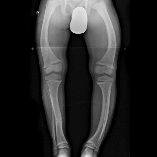 effektivnye-metody-diagnostiki-i-lecheniya-sindroma-osteomalyatsii
