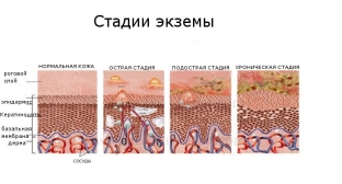 ekzema-trebuet-kompleksnoj-terapii-s-uchetom-individualnykh-osobennostej-patsienta