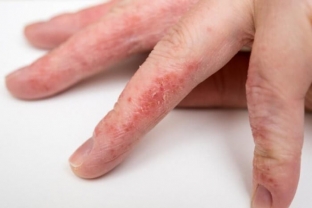 ekzematoznyj-dermatit-simptomy-i-metody-lecheniya-zabolevaniya