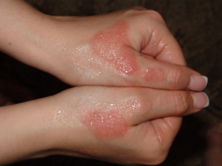 ekzematoznyj-dermatit-simptomy-i-metody-lecheniya-zabolevaniya