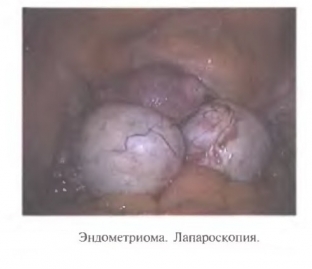 endometrioz-yaichnikov-kakimi-simptomami-mogut-proyavlyatsya-shokoladnye-kisty