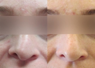 esteticheskaya-korrektsiya-nosa-vozmozhnosti-fillerov