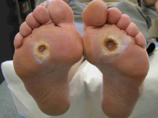 faktory-sposobstvuyushchie-razvitiyu-diabeticheskoj-stopy-foto