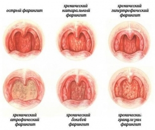 faringit-klassifikatsiya-prichiny-i-simptomy-bolezni