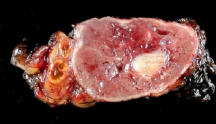 feokhromotsitoma-kogda-povyshennoe-davlenie-govorit-ob-opukholi-nadpochechnikov