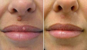 fibroma-kozhi-raznovidnosti-diagnostika-i-metody-terapii