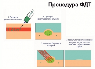 fotodinamicheskaya-terapiya-v-lechenii-raka-molochnoj-zhelezy