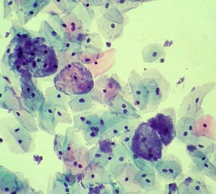 gardnerellez-urogenitalnyj-etiologiya-klinika-diagnostika-i-lechenie