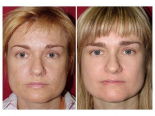 garmoniya-omolozheniya-harmony-xl-pro-ot-alma-lasers-reshenie-shirokogo-spektra-esteticheskikh-problem
